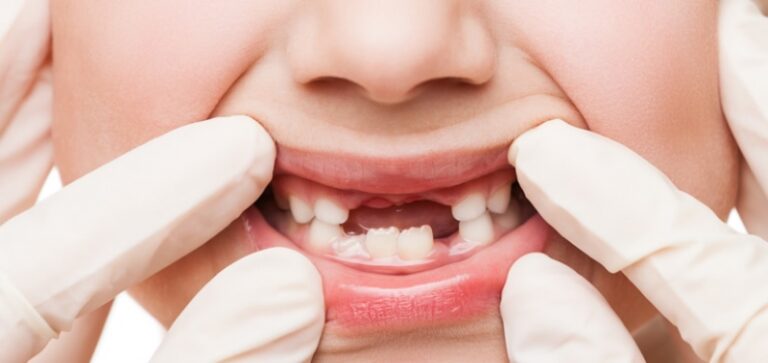 Çocuk Diş Sağlığının Önemi